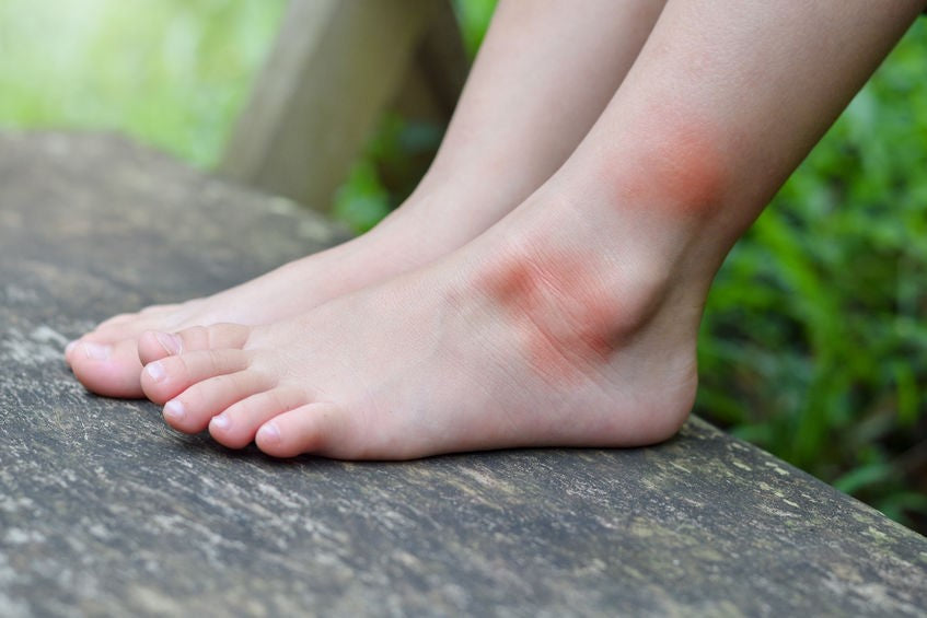 Skeeter Syndrome: Diagnosis and Treatment Options
