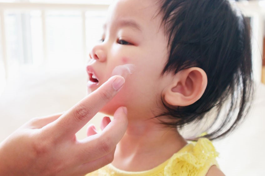 Best Ways to Treat Mosquito Bites on Kids