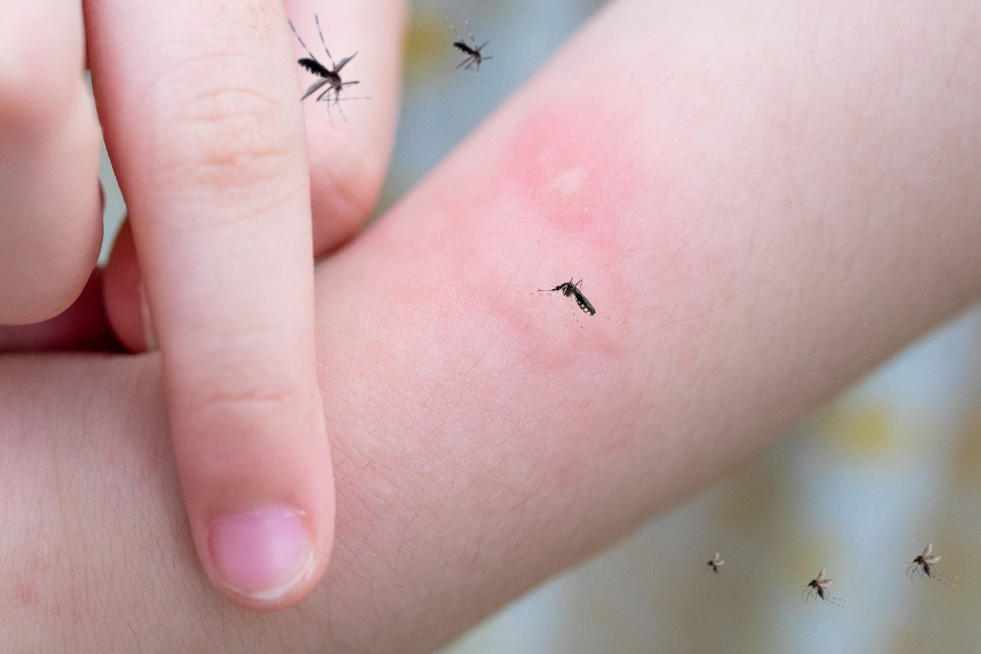 How to Care for Bug and Insect Bites
