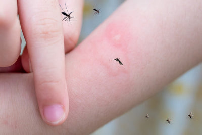 How to Treat Bruises With Mosquito Bites - MosquitoNix®